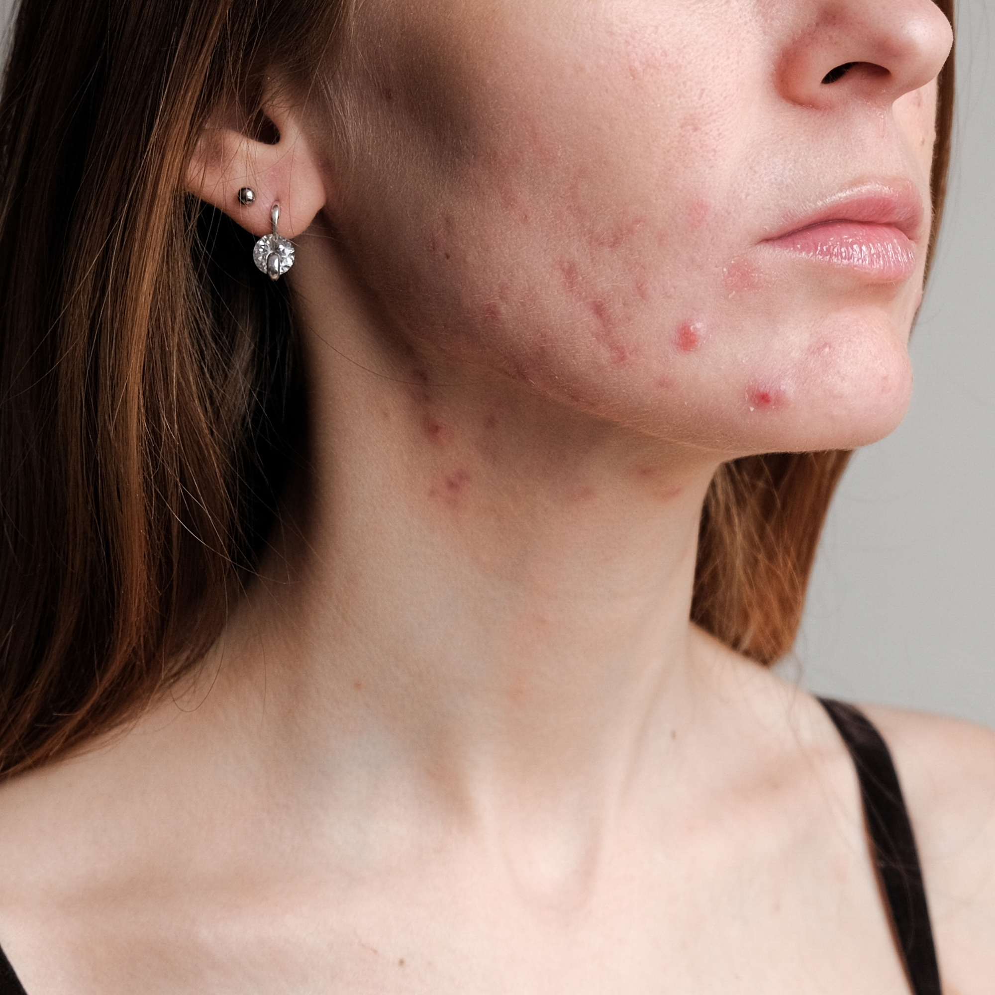 Learn how to fix your acne in 8 weeks